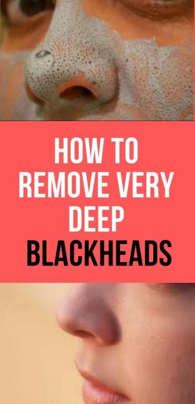 Effortless Techniques to Eliminate Blackheads with Egg White