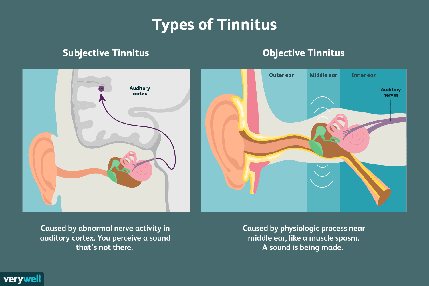 Understanding the Two Types of Tinnitus