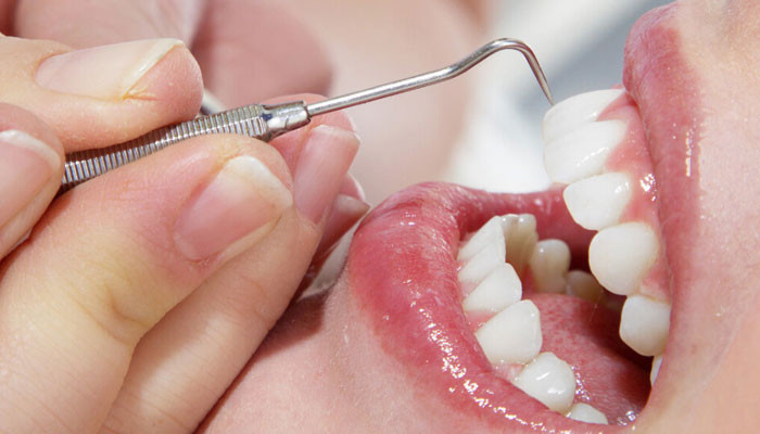 How to Remove Cavity from Teeth in Urdu