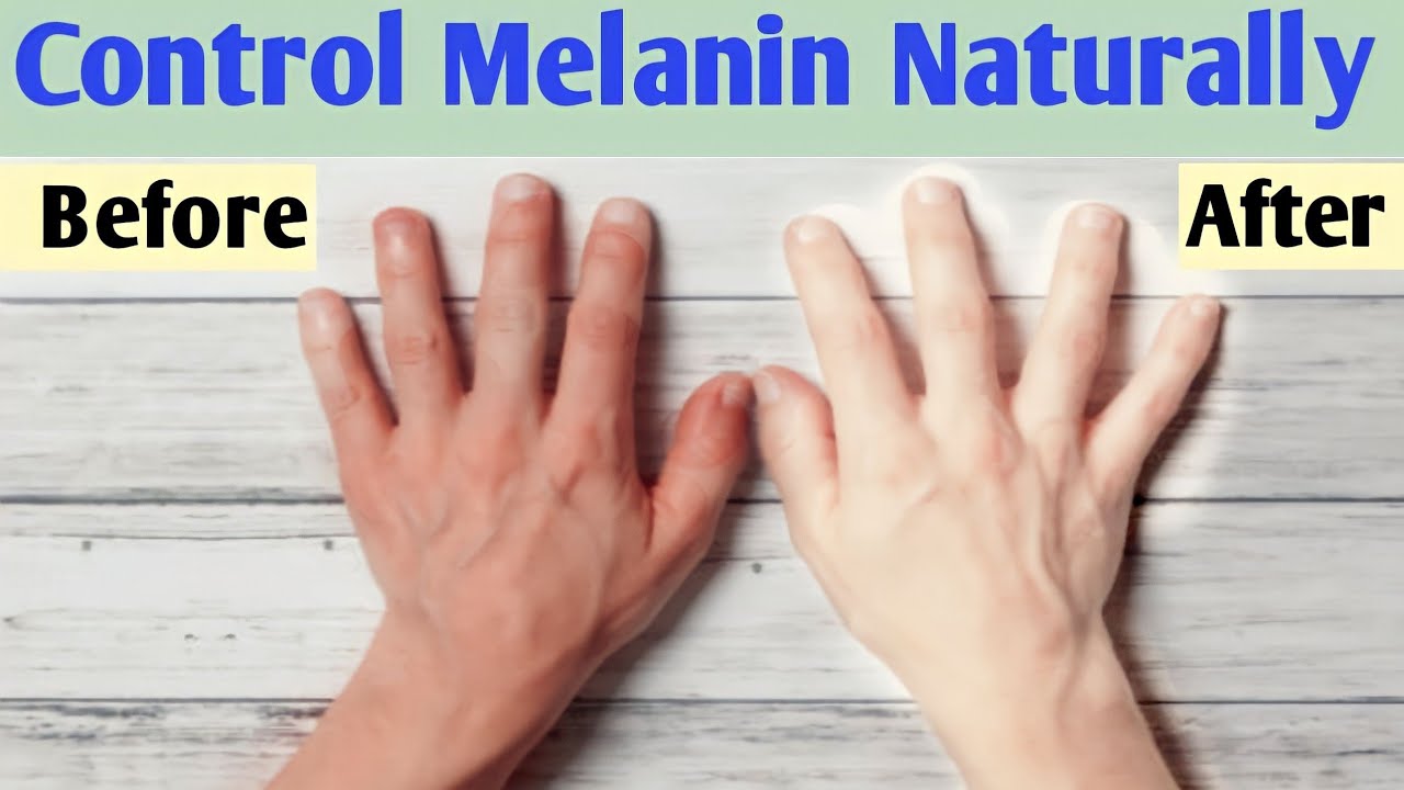 How to reduce melanin in skin naturally  Melanin kam karne ke upay 