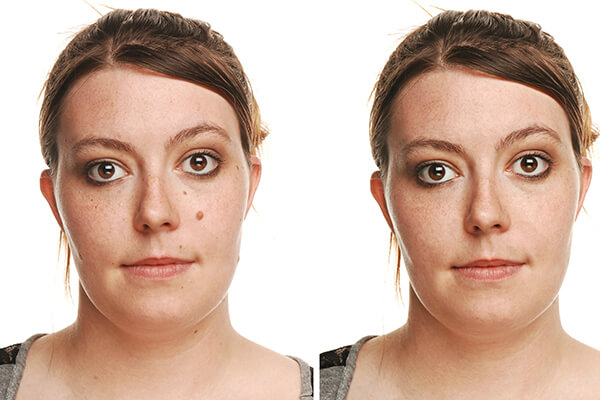 Mole Removal Mole  Skin Tag Removal Mole Removal Face Dhanmondi 