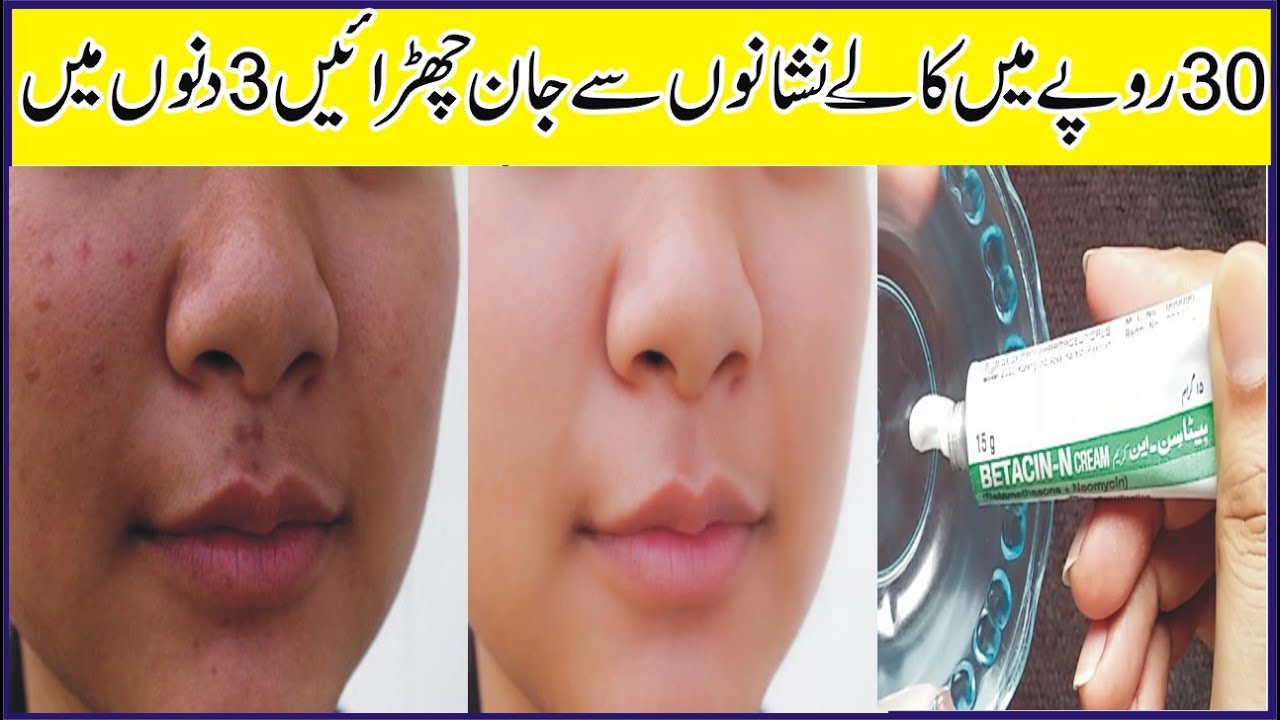 How to Remove Dark Spots Brown Spots Melasma Home Remedy Beauty Tips In 
