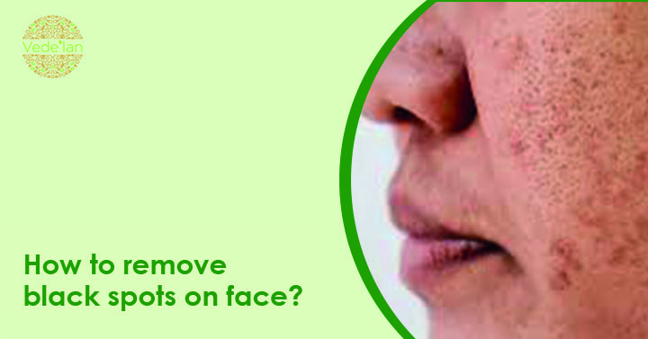 How To Remove Black Spots On Face  Vedelan
