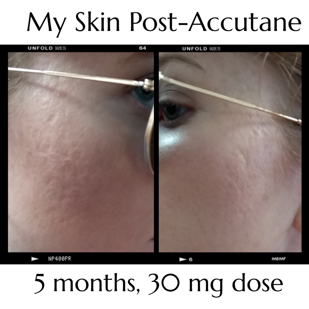 Accutane Results