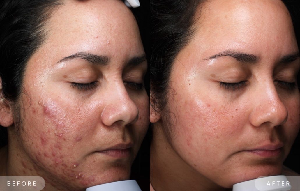Accutane Results