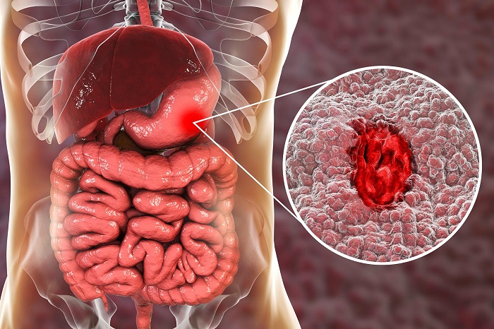 How to Diagnose Stomach Ulcer in Urdu