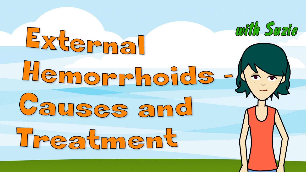 External Hemorrhoids  Causes and Treatment  YouTube