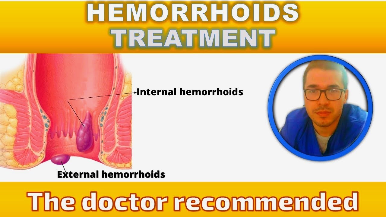 How to Remove External Hemorrhoids at Home in Urdu