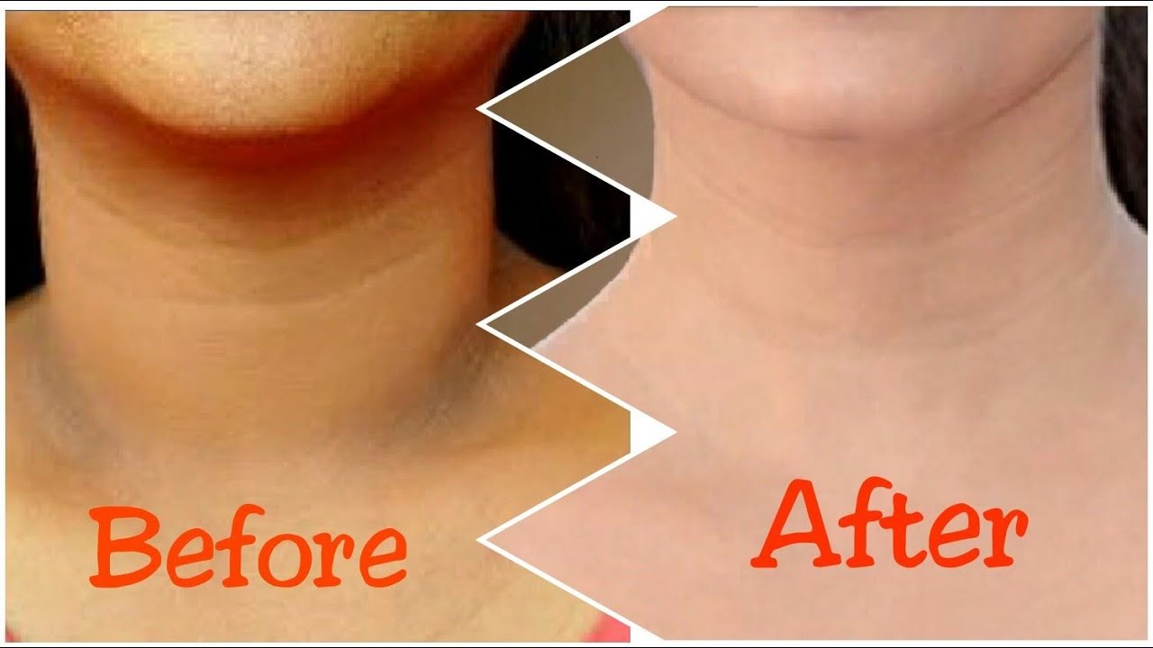 Get Rid Of Black Neck in Summer Season       