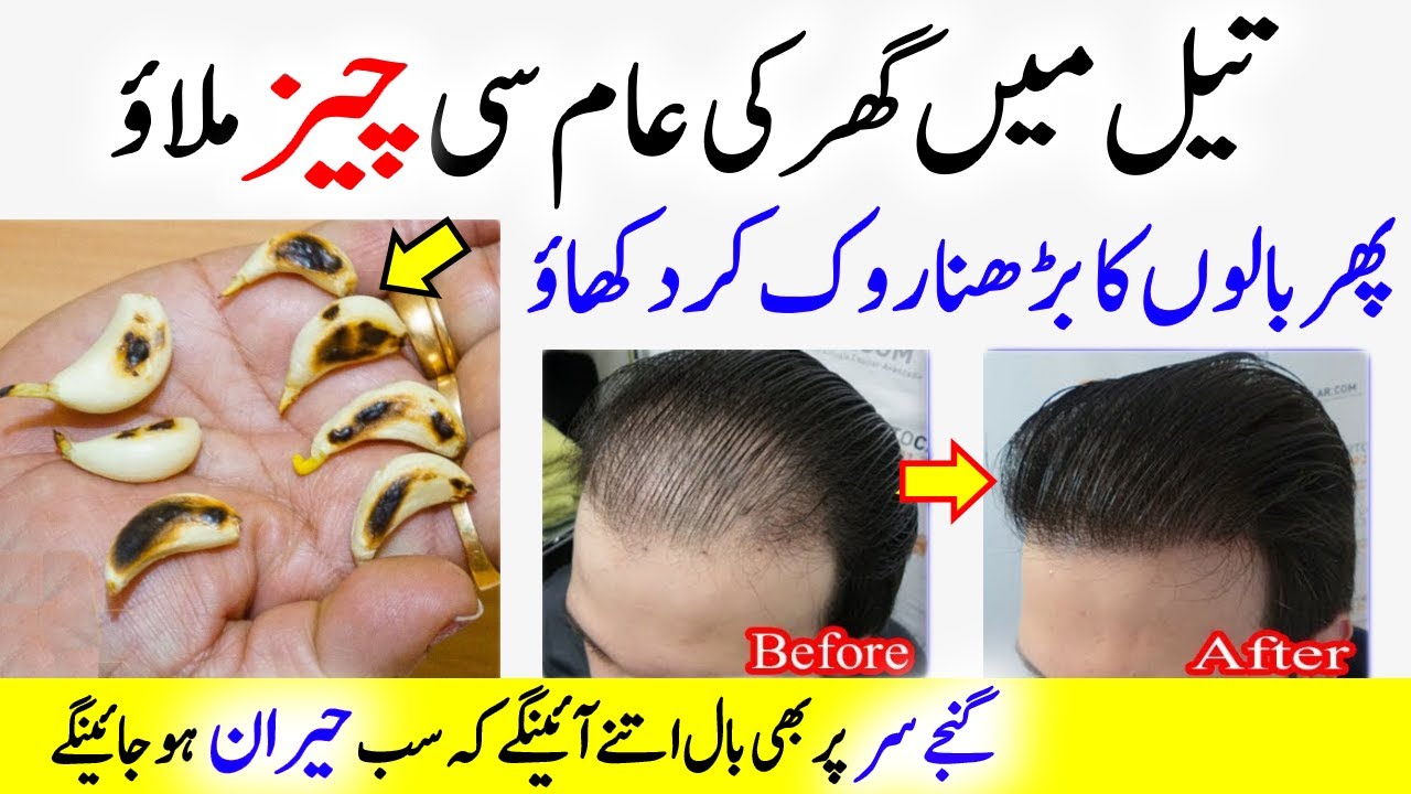 How to Stop Hair Receding in Urdu