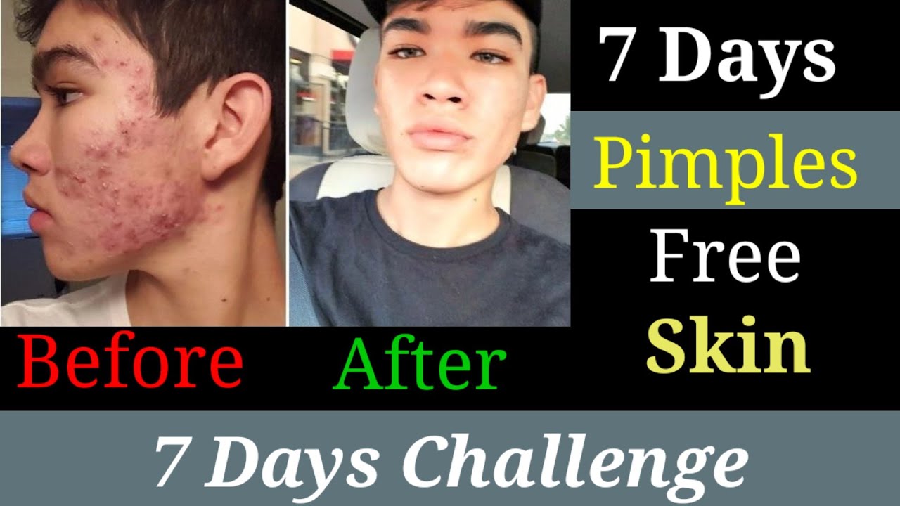 Pimples kaise thik kare  how to remove pimples pimples treatment 