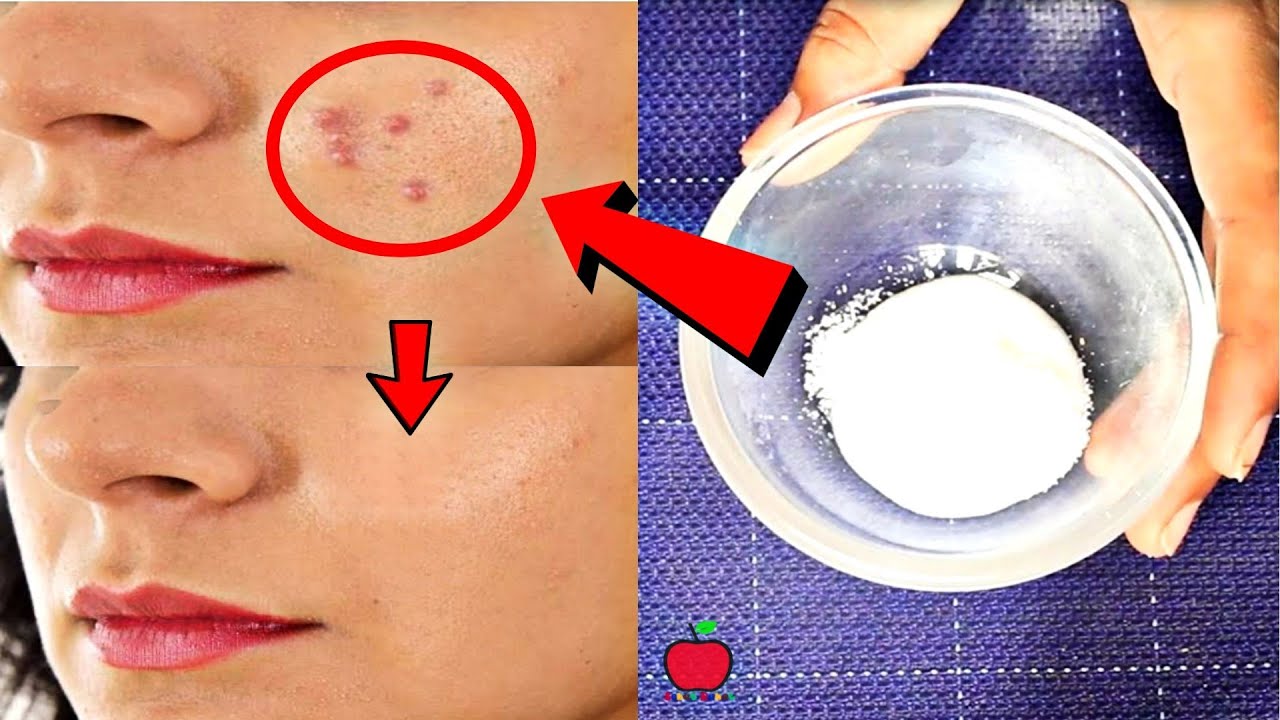 Pimples  Acne             