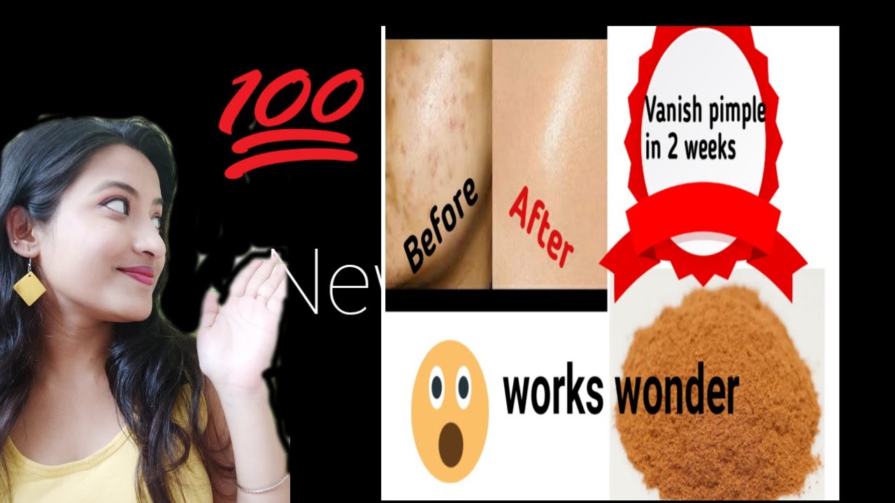 Pimple treatment  pimple kaise Kam kare  acne reduce  pimple 