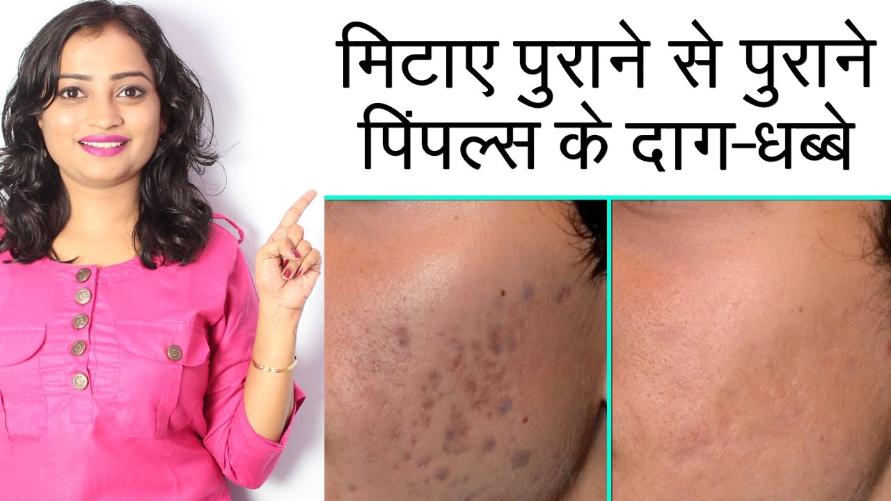 How to Remove Pimples in One Day in Urdu
