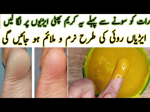 cracked heels home remedy         