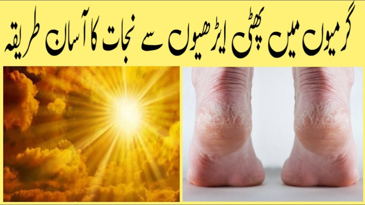 Crack Heel Treatment         Healthy 