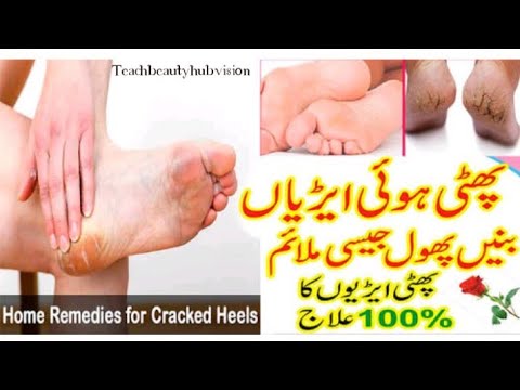 Crack Heels Treatment At Home  Remove Crack Heel  Get Beautiful Foot 