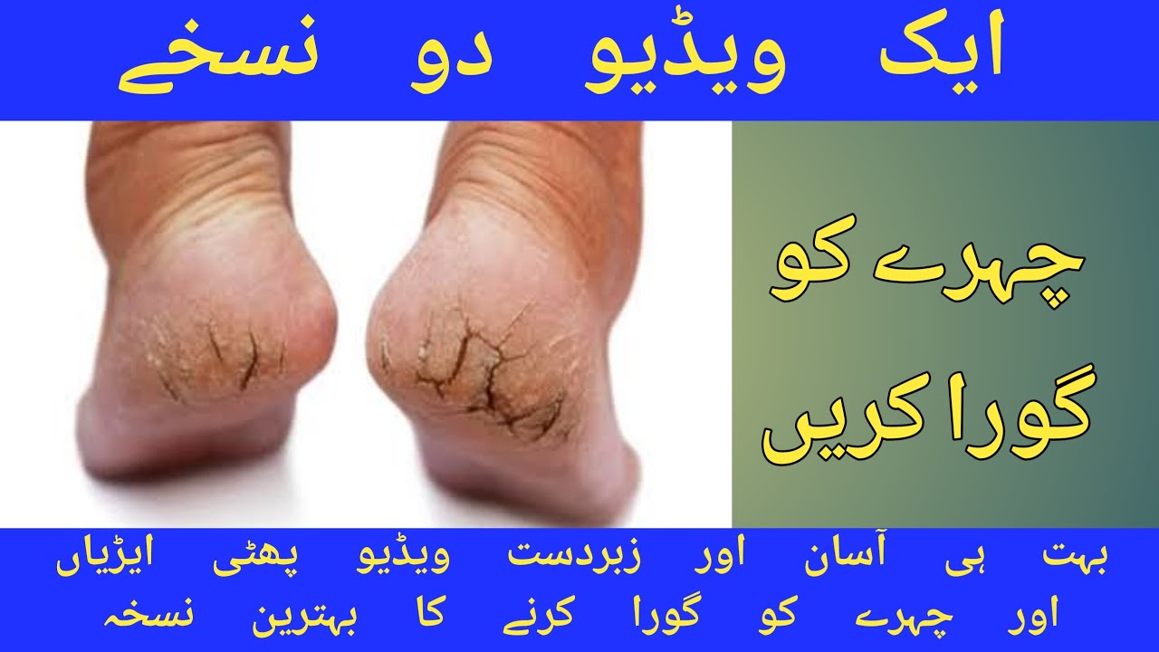 How to Cure Cracked Heels in Urdu