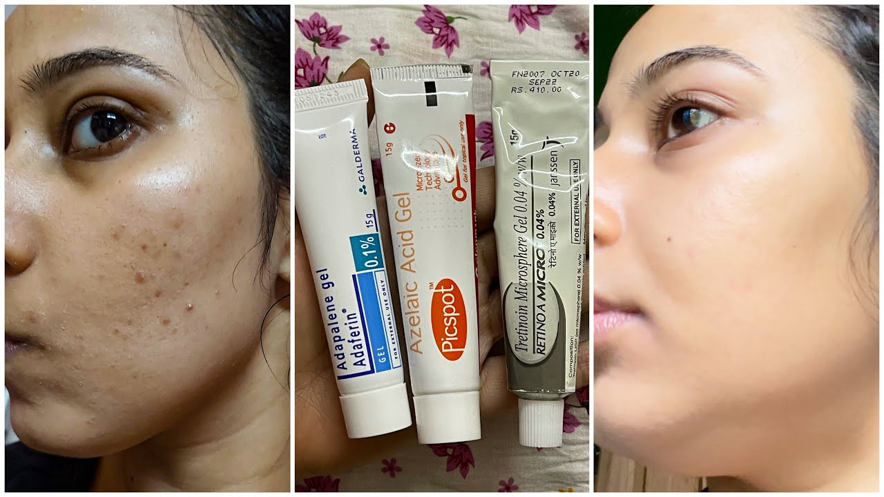 Remove Acne Marks 6 Easy Quick Ways To Remove Acne Ma  vrogueco
