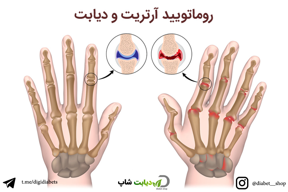 How Are Different Types of Arthritis Causes in Urdu