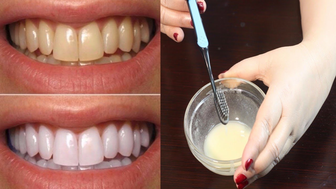How To Whiten Teeth  Best Teeth Whitening Method  Teeth Whitening At 