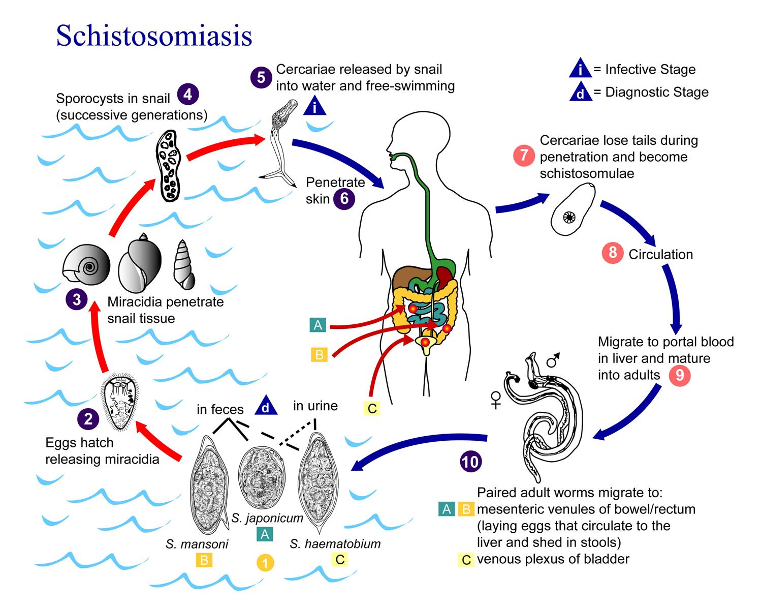 How Does Schistosomiasis Cause Portal Hypertension in Urdu