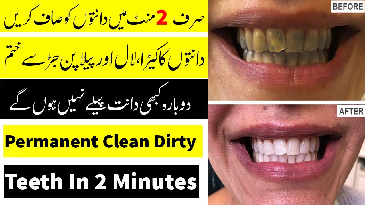 Best Method For Teeth Whitening At Home  How To Clean Teeth At Home 