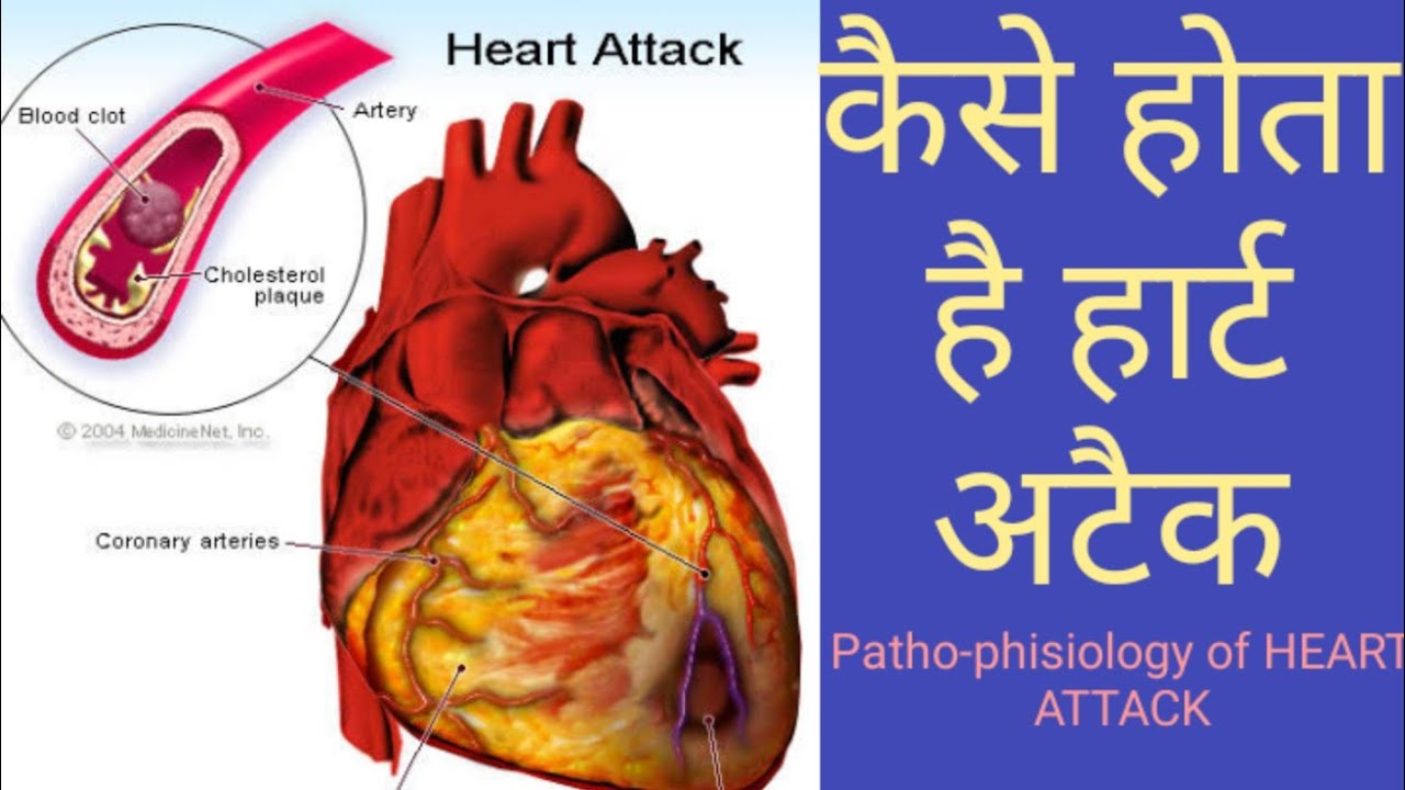 HEART ATTACK KAISE HOTA HAI HEART ATTACK KYU AATA HAI HEART ATTACK 