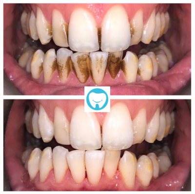 How to Remove Black Stains from Teeth in Urdu