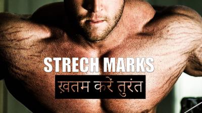 How to Remove Stretch Marks Permanently in Urdu