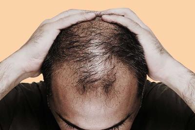 How Many Hair Loss Per Day Is Normal for Men in Urdu