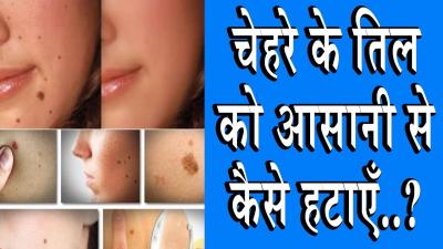 How to Remove Moles from Face in Urdu