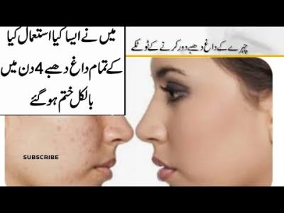 How Long Does It Take for Acne Scars to Fade in Urdu