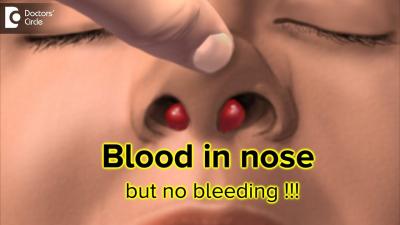 How to Stop Nose Bleeding at Home in Urdu