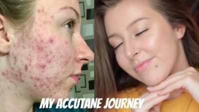 How Many Courses of Accutane Can You Take in Urdu