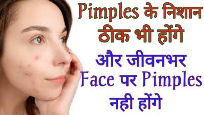How to Remove Pimples in One Day in Urdu