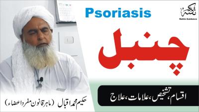 How to Treat a Burn Bubble in Urdu