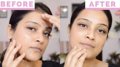 How to Avoid Acne Marks in Urdu