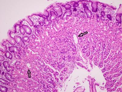 How Does Schistosomiasis Cause Portal Hypertension in Urdu