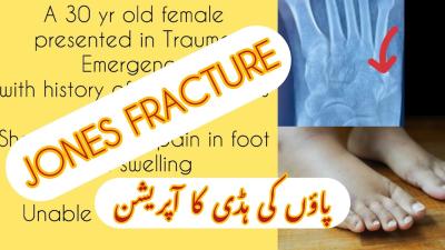 How to Break a Bone in Urdu