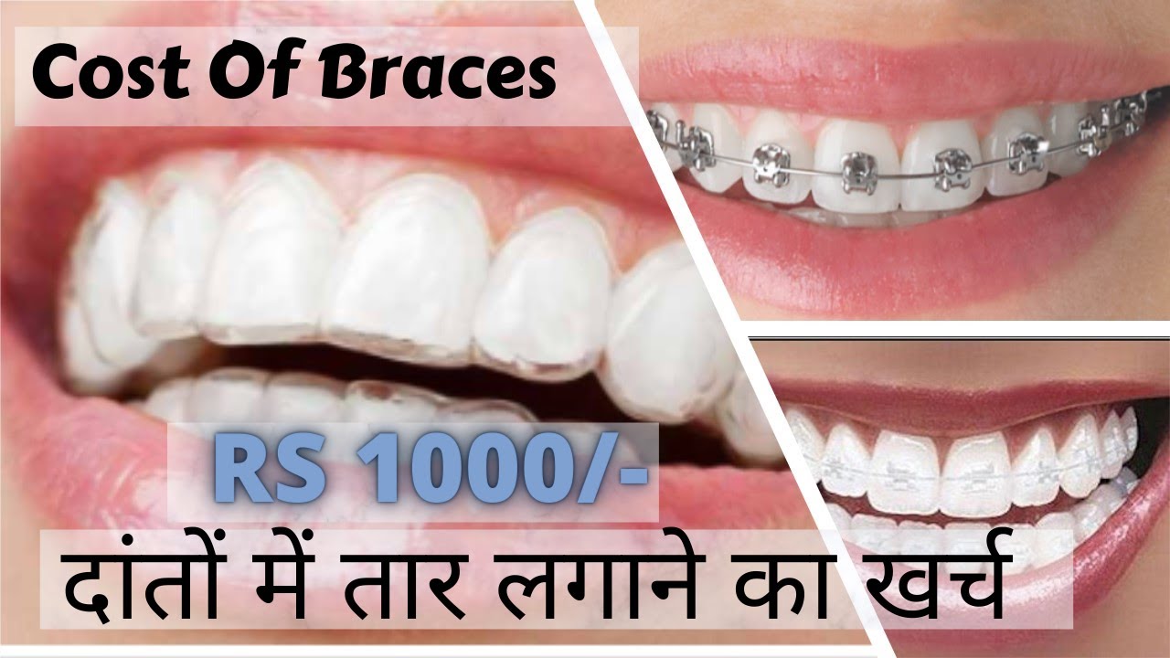 Brace Teeth Price