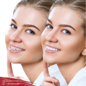 How Much Do Braces Cost in Pakistan in Urdu