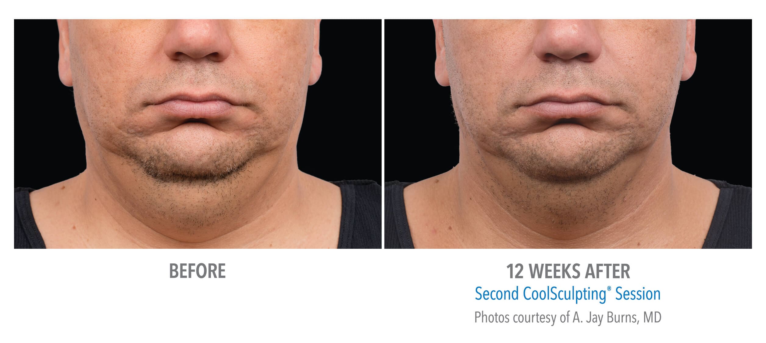 Double Chin Reduction  Before  After Photos Healthy Solutions
