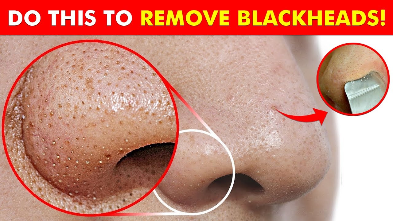 How to Remove Blackheads in Urdu