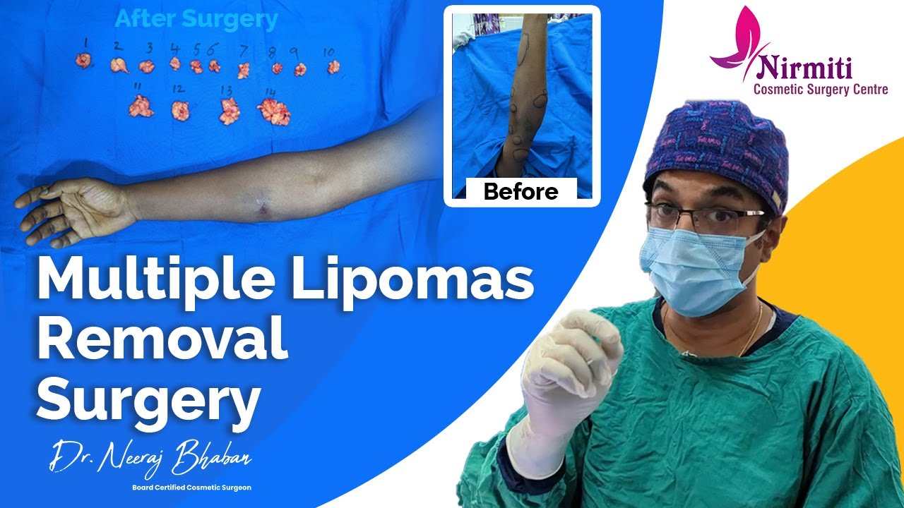 Multiple Lipomas Removal Surgery by Dr Neeraj Bhaban  YouTube