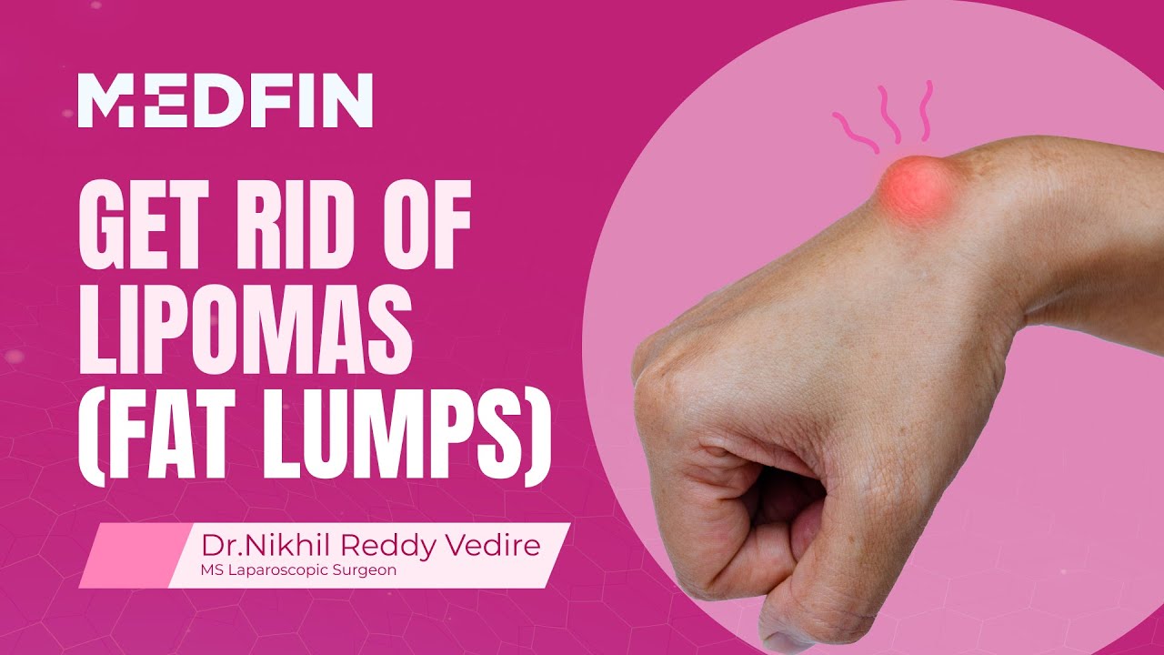 Lipoma Treatment Diagnosis Necessity and Procedure Explained  YouTube
