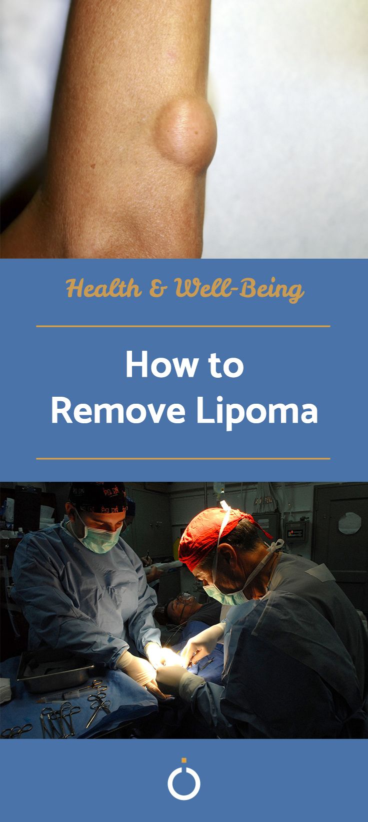 How to Remove Lipoma  How to remove Lipoma removal Healthy lifestyle 