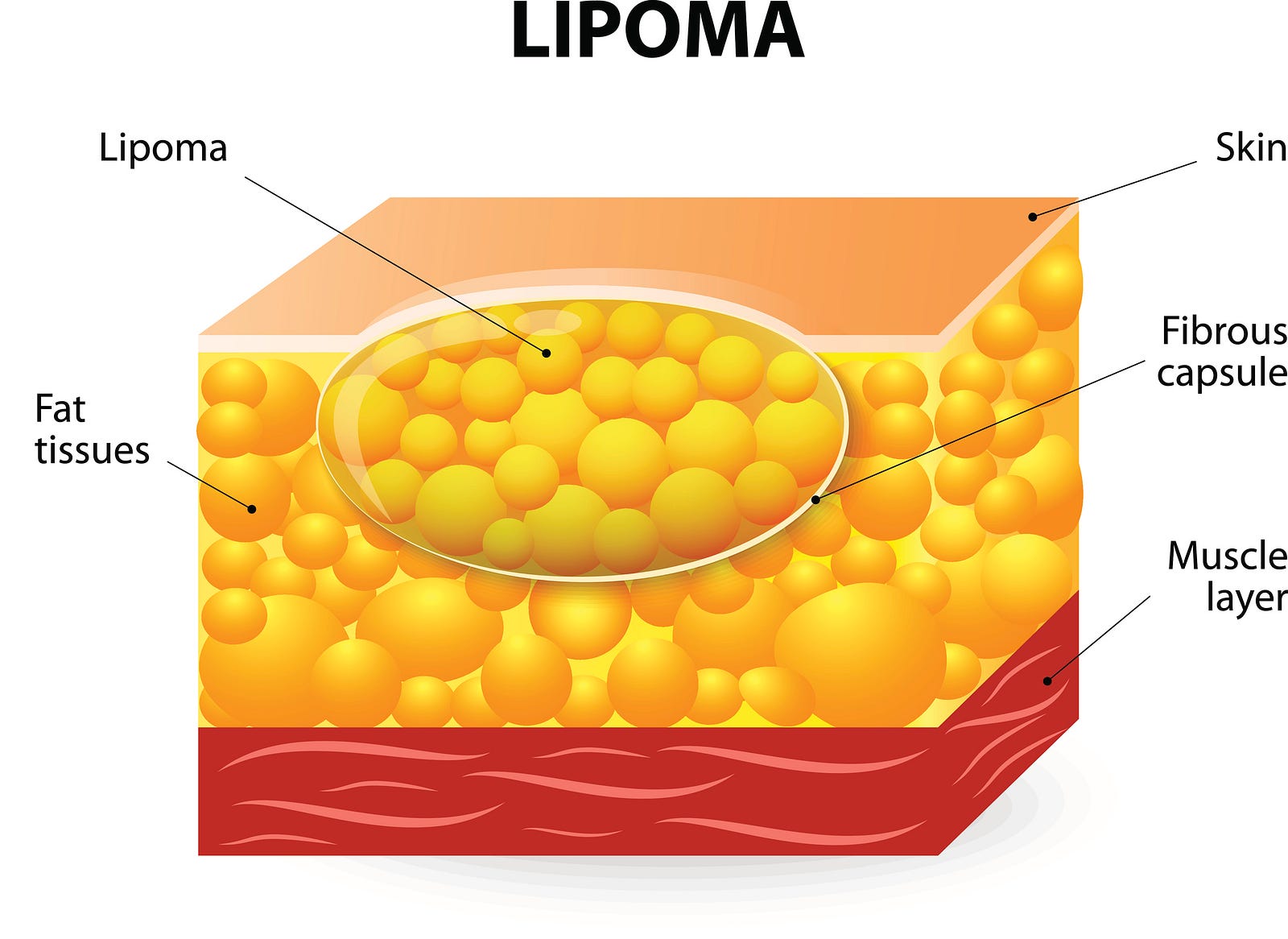 How to Remove a Lipoma Yourself in Urdu