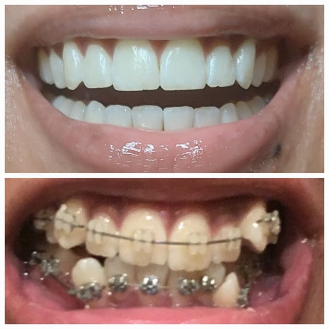 19 months into my braces journey Finishing up the closing of my 