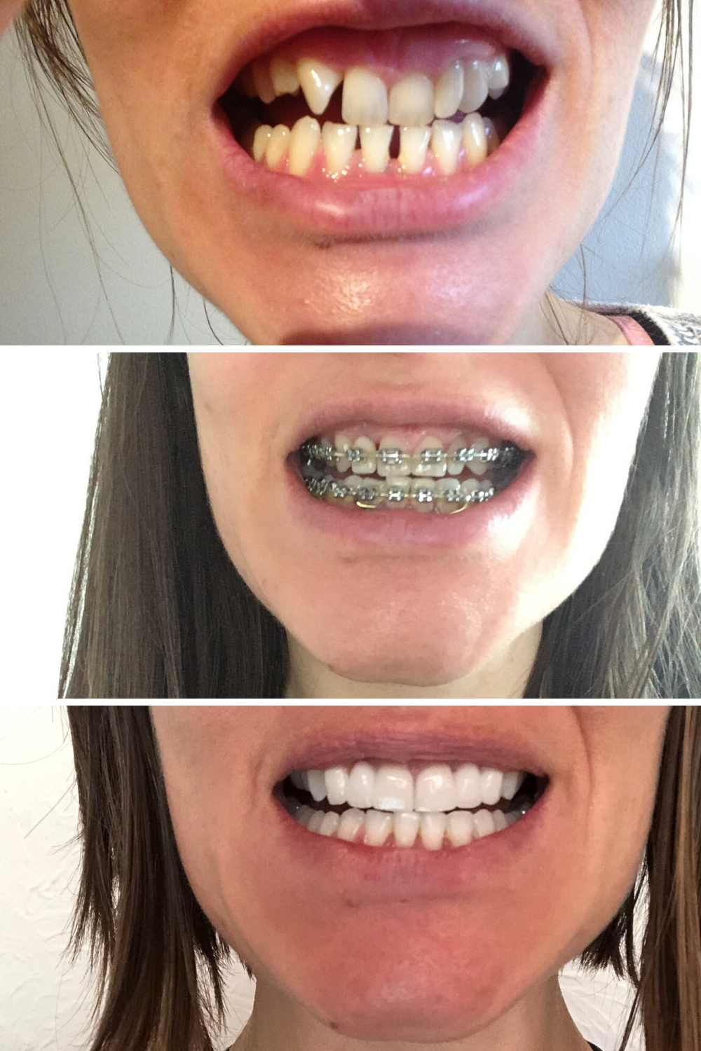 how do braces work to close gaps  Bernita Pond